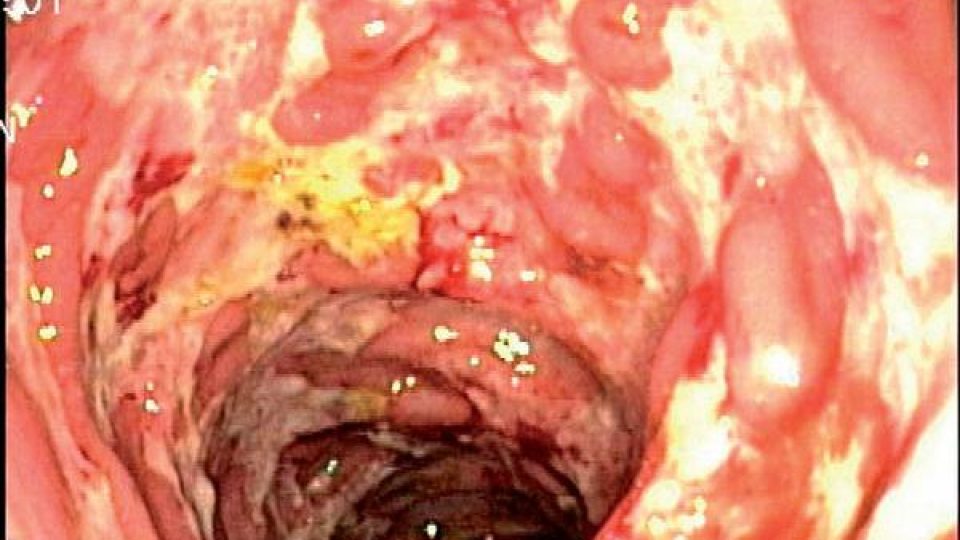 Ulcerózní kolitida - akutní stadium střevního zánětu